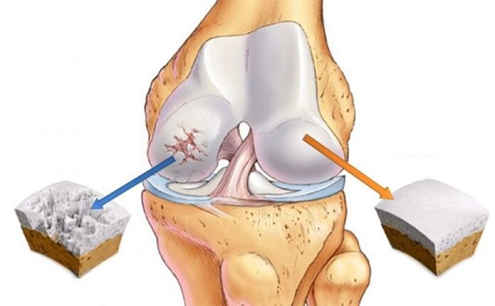 healthy cartilage and osteoarthritis of the knee