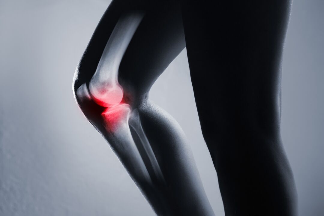 inflammation of the knee joint with osteoarthritis