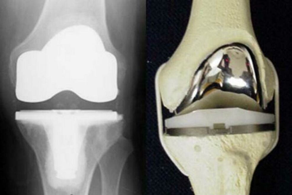 knee joint replacement due to osteoarthritis