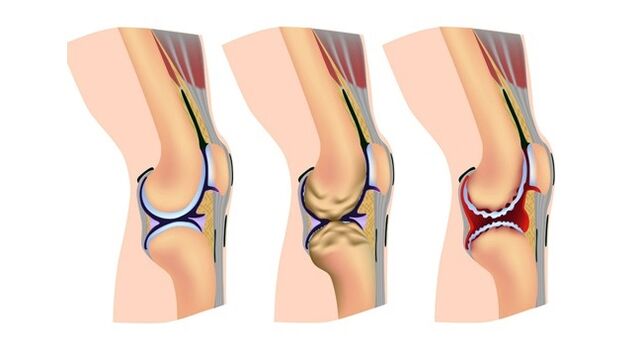 stage of osteoarthritis of the knee joint