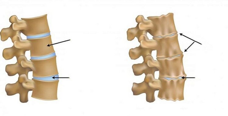 Ischemic Osteochondrose syndrome