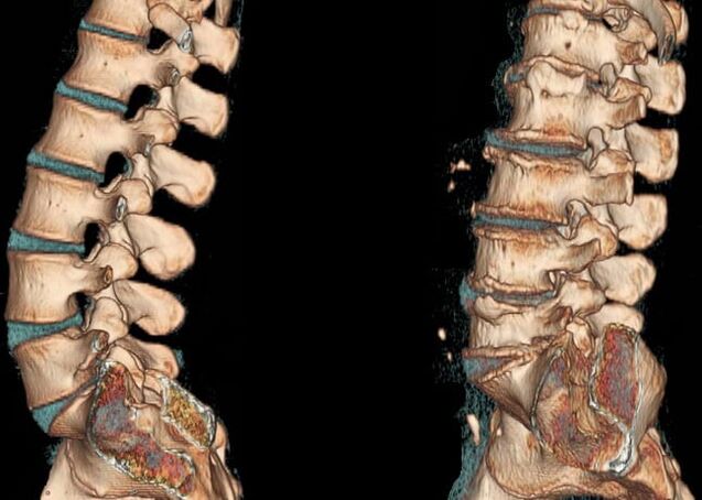 Osteochondrose of the lumbar region