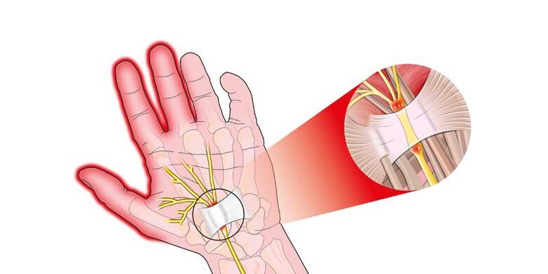 Finger joint pain with risartrosis