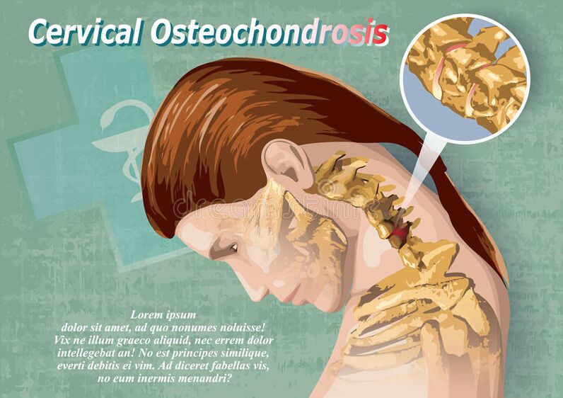 Cervical osteohondrose is the disease of tissue cartilage
